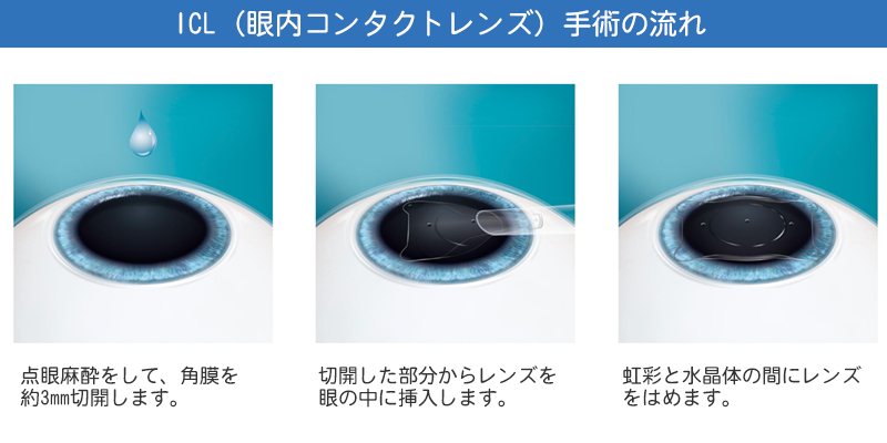 ICL(眼内コンタクトレンズ)