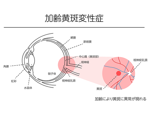 加齢黄斑変性