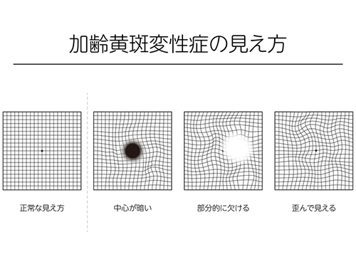 加齢黄斑変性