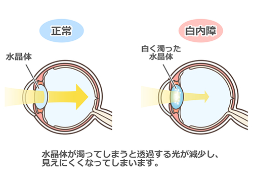 白内障