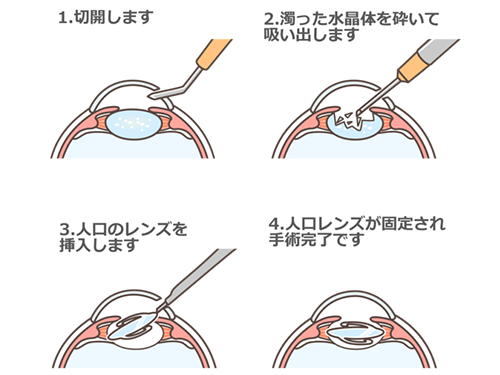 白内障手術について