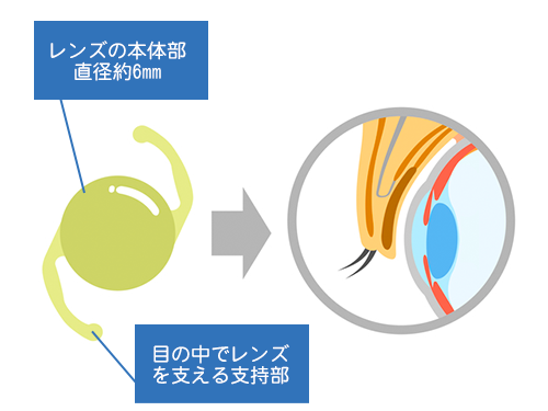 眼内レンズ