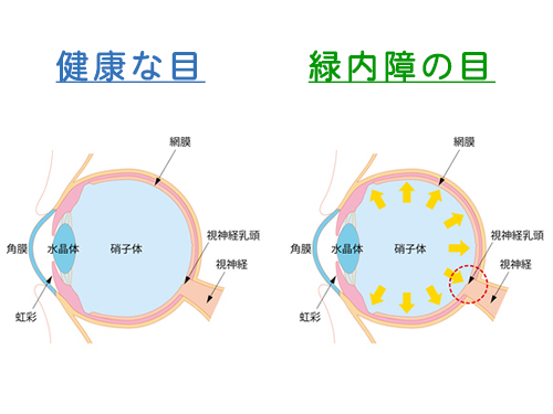 緑内障